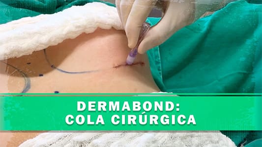 Dermabond para cirurgia de prótese de mama