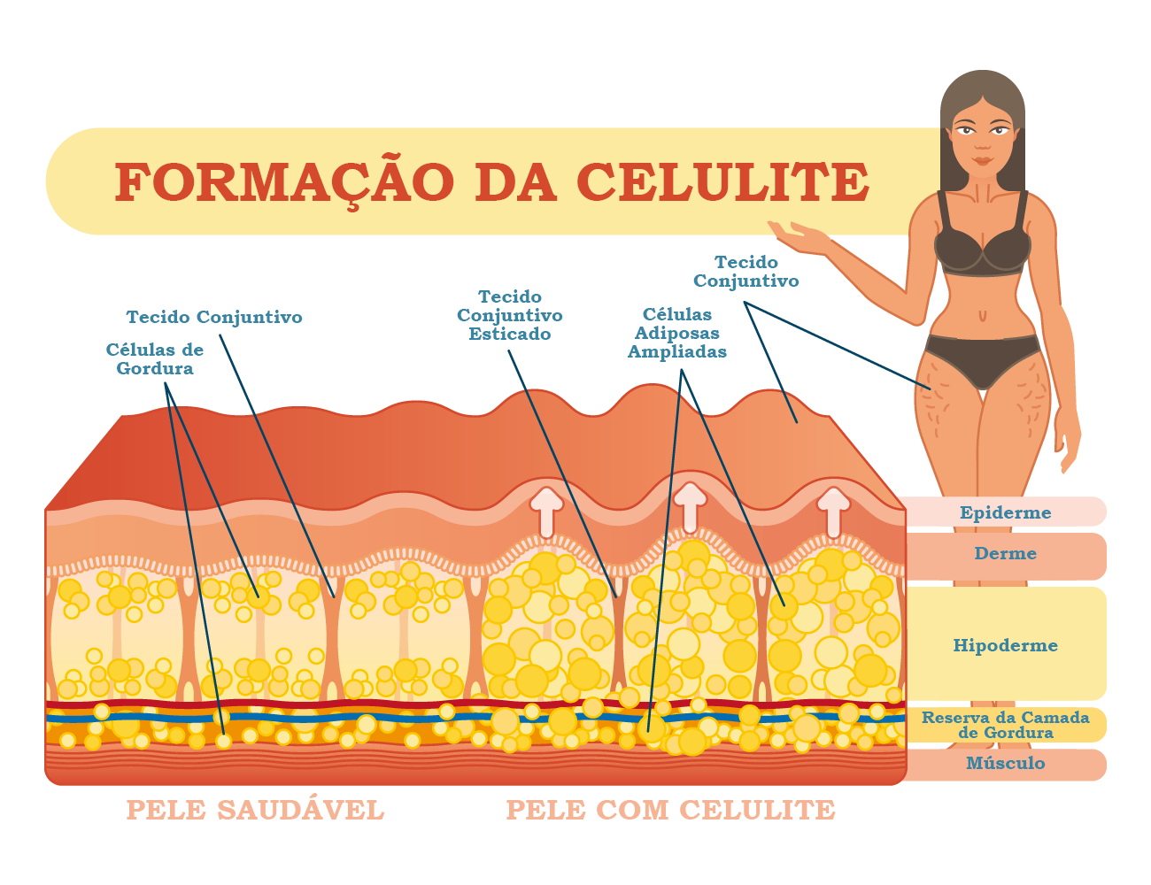 Dr Frederico Fernandes - Programa Plástica e Beleza - Celulite (Subcision)