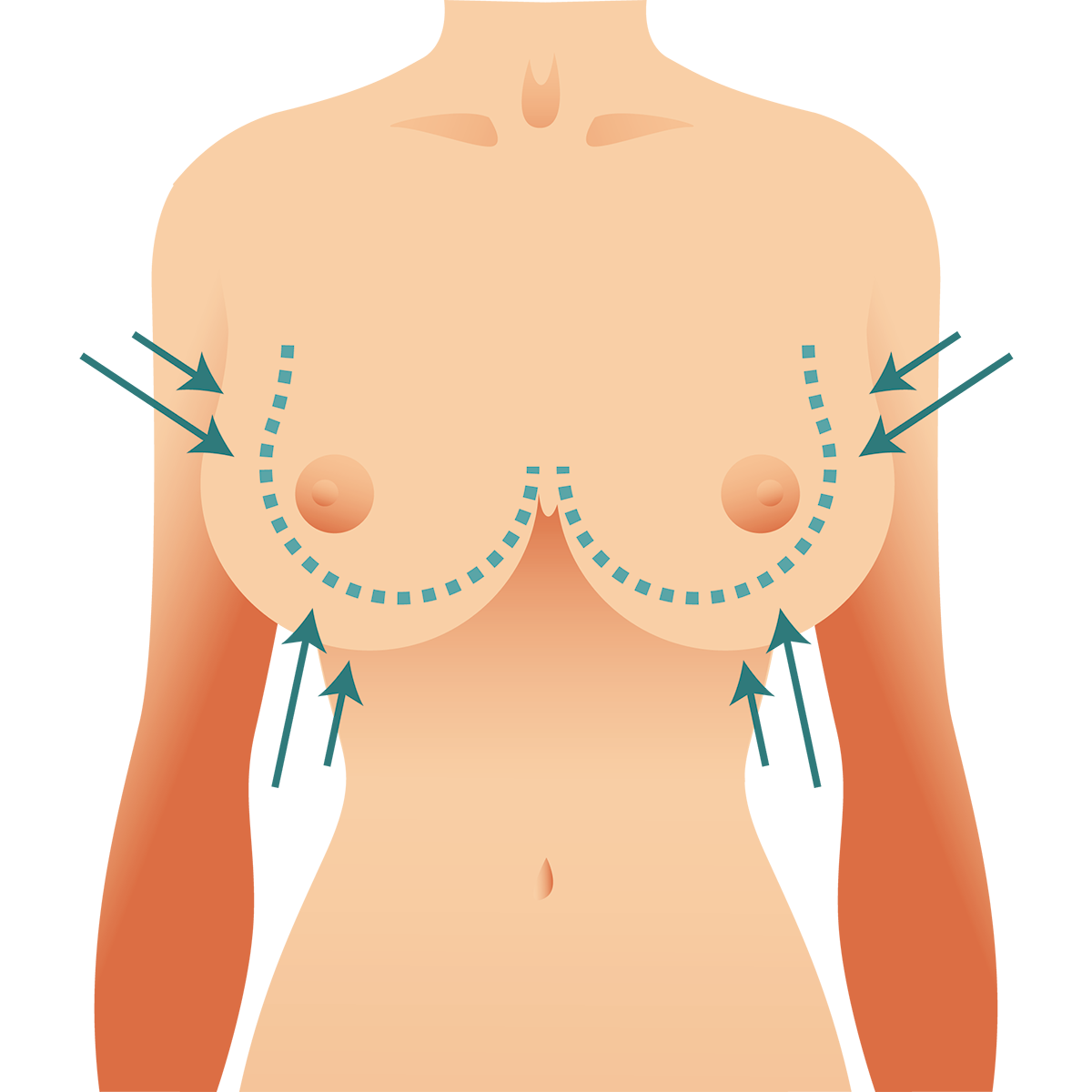 Dr Frederico Fernandes - Cirurgia Plástica Estética - Mamoplastia Redutora (Redução de Mamas)